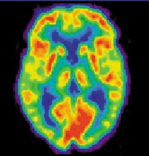AC2 - Healthy brain scan.jpg