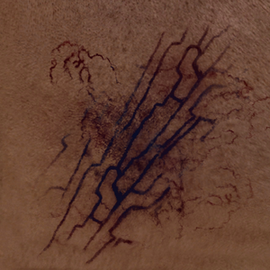 ACV ISU BIRTHMARK.png