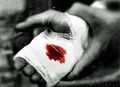 Emmanuel's injured hand