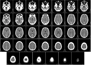 AC2 - Brain tomography.png