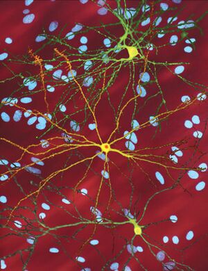 AC2 - Huntingson's disease.jpg